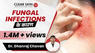 Fungal Infection Causes In Hindi फंगल इन्फेक्शन के कारण  ClearSkin Pune [upl. by Ire]