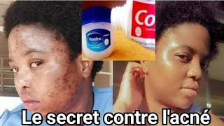 Comment traiter les boutons sur le visage  Un remède fait maison contre lacnéColgate et Vaseline [upl. by Feodor453]