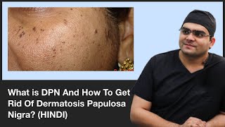 What is DPN And How To Get Rid Of Dermatosis Papulosa Nigra  ClearSkin Pune  In HINDI [upl. by Solracnauj607]