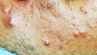 Extraction dacné kystique et pustule  cystic acne [upl. by Airekahs19]