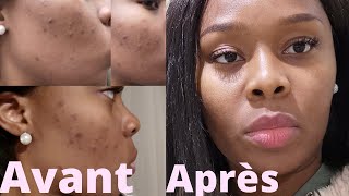 COMMENT se débarrasser des BOUTONS et TACHES sur le visage  ROUTINE Ducray  Samantha MK [upl. by Ainollopa]