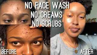 I QUIT USING ACNE PRODUCTS TO CLEAR MY SKIN WPhotos [upl. by Yoral]